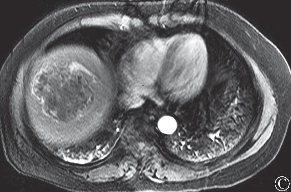 第五节 肝血管平滑肌脂肪瘤